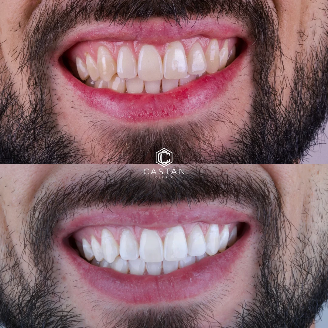Antes e depois de clareamento dental — caso real