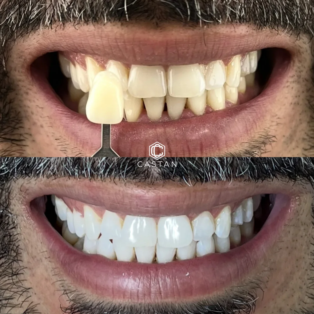 Antes e depois de clareamento dental — caso real