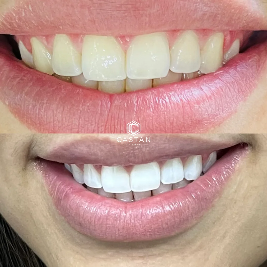 Antes e depois de clareamento dental — caso real