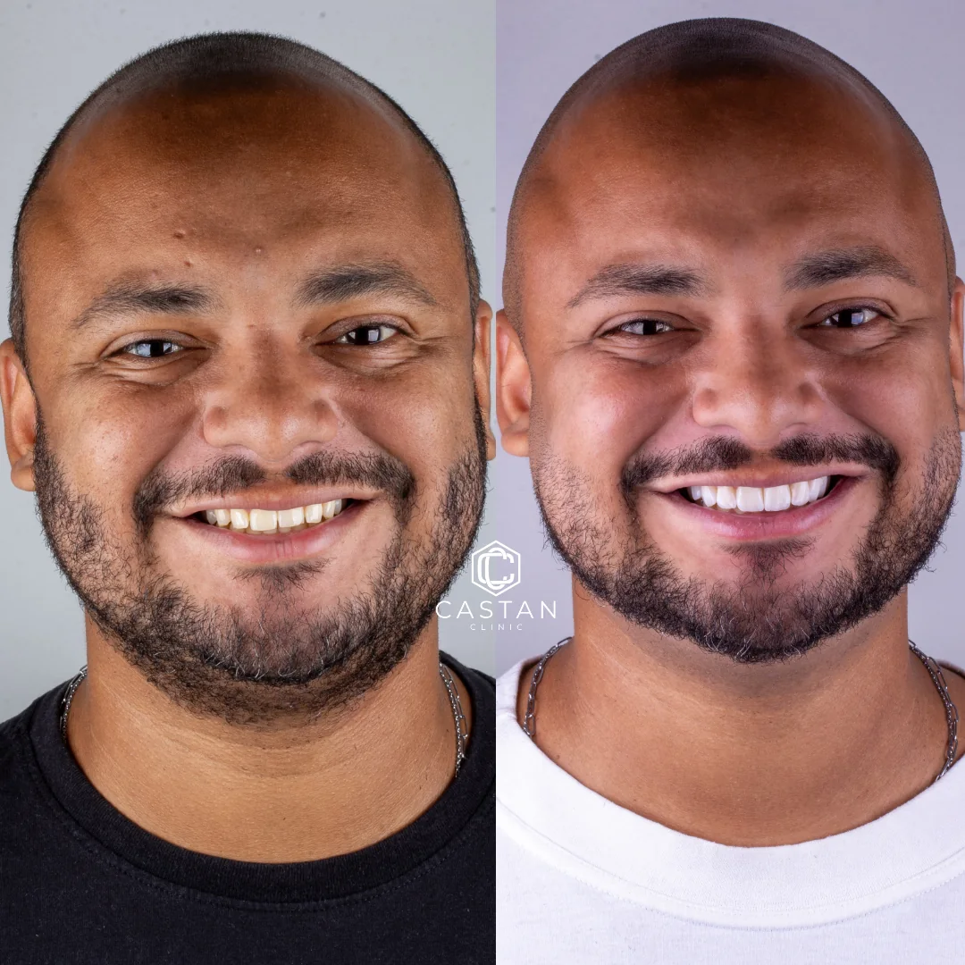Antes e depois de lentes dentais — caso real