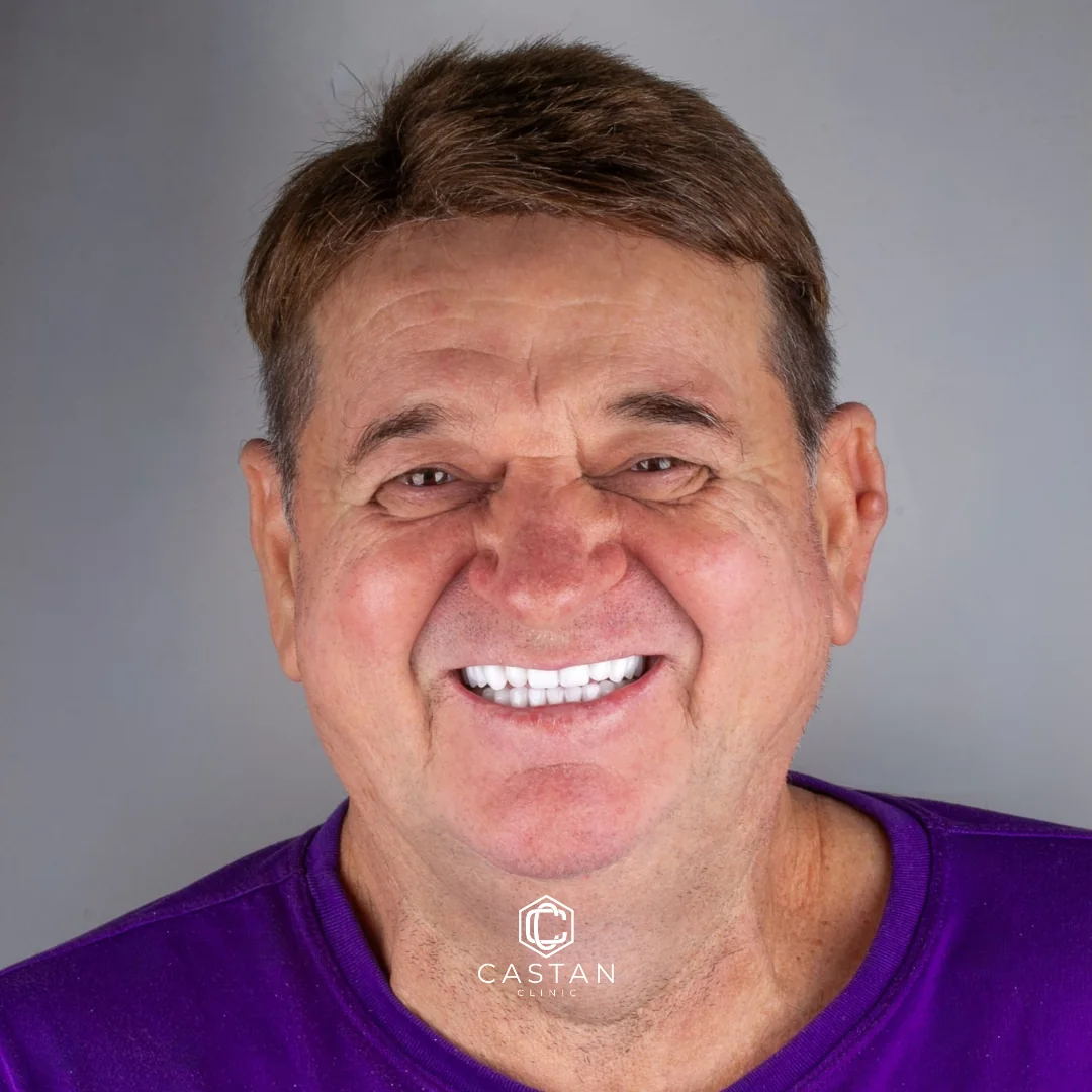Resultado com lentes dentais — caso real